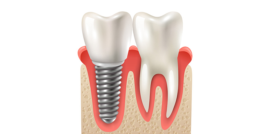 Dental Implant